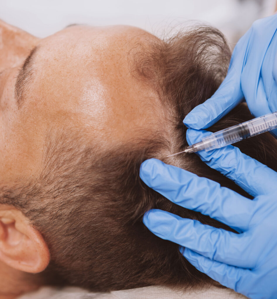 Person receiving PRP injection in scalp